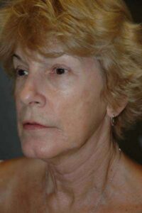 Facelift
