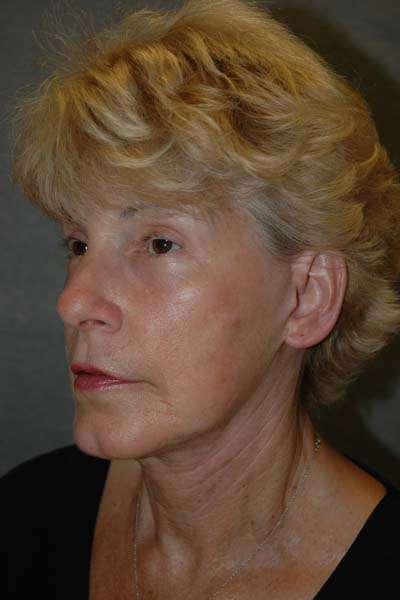 Facelift