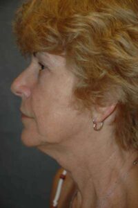 Facelift