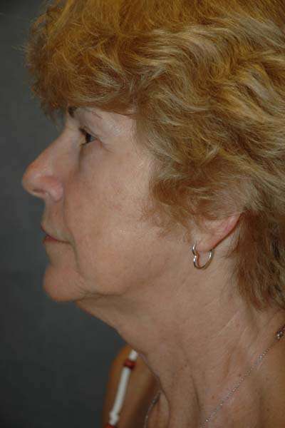 Facelift