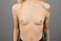 Breast Augmentation