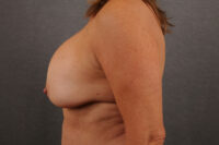 Breast Lift