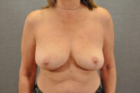 Breast Lift