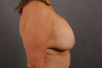 Breast Lift