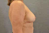 Breast Lift