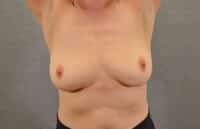 Breast Implant Removal