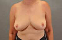 Breast Implant Removal
