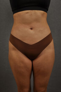 Liposuction