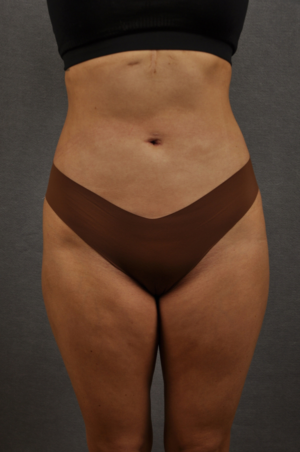Liposuction Case 20045 After Photo Liposuction