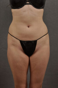 Liposuction