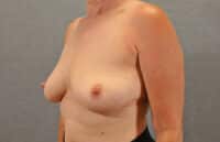 Breast Implant Removal