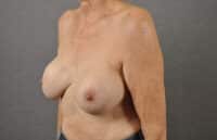 Breast Lift