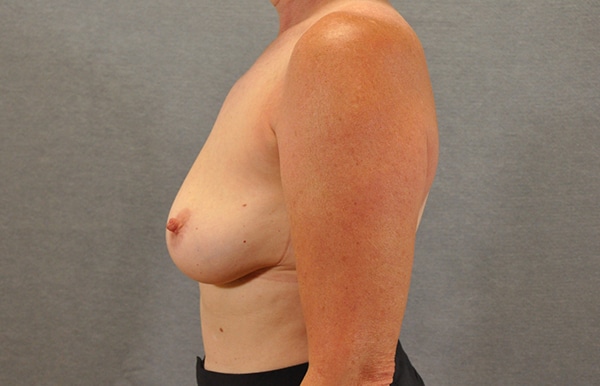 Breast Implant Removal