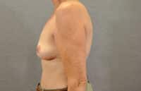 Breast Lift