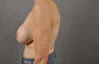 Breast Lift
