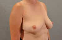 Breast Implant Removal