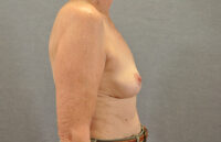 Breast Lift