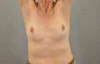 Breast Lift