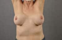 Breast Lift