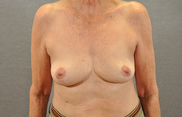 Breast Lift Case 20342 After Photo Breast Lift