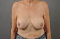 Breast Lift