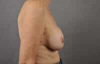Breast Lift