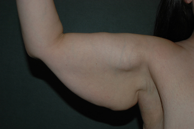 ARM LIFT Before and After Results