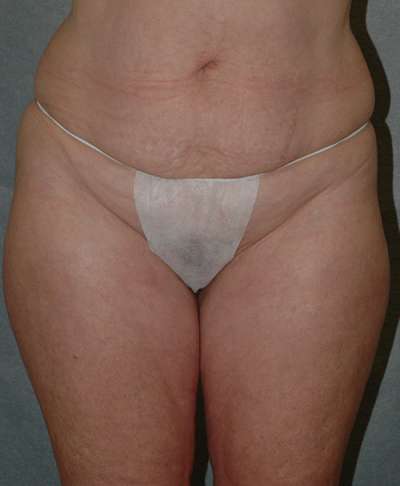 LIPOSUCTION Before and After Results