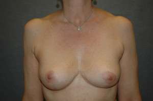 BREAST IMPLANT REMOVAL Before and After Results