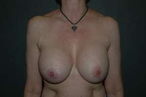 BREAST IMPLANT REMOVAL Before and After Results