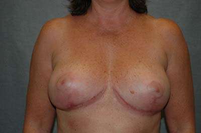 BREAST LIFT Before and After Results
