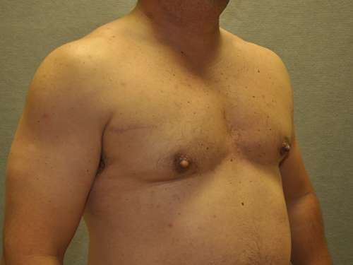 GYNECOMASTIA Before and After Results