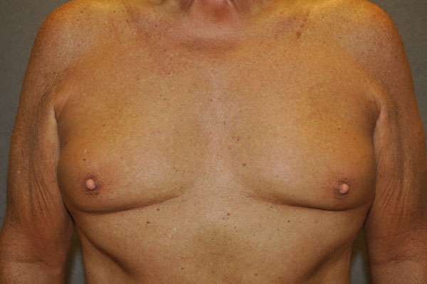 NIPPLE REDUCTION Before and After Results