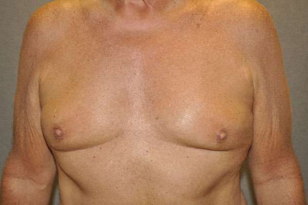 NIPPLE REDUCTION Before and After Results