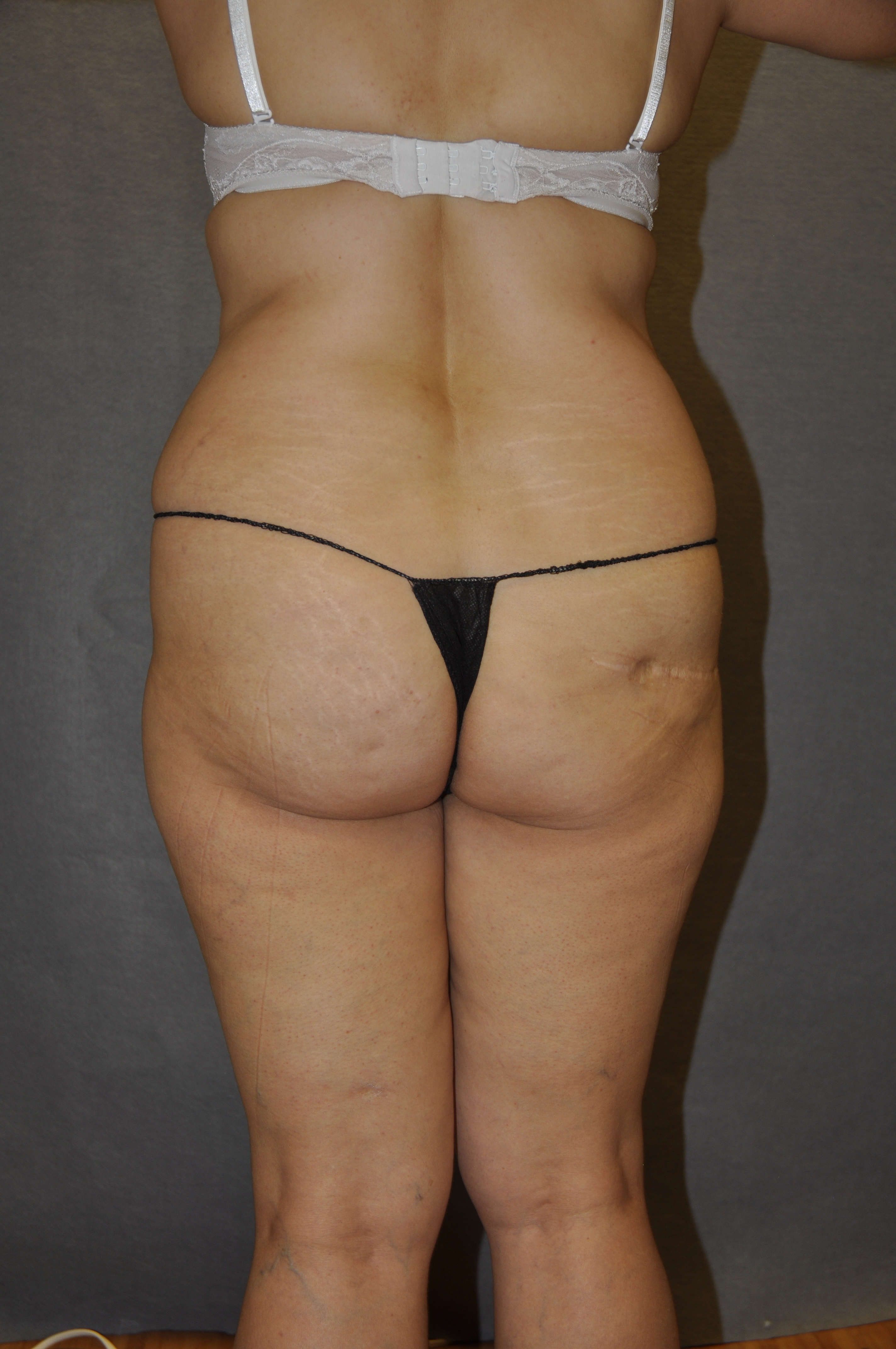BRAZILIAN BUTT LIFT Before and After Results
