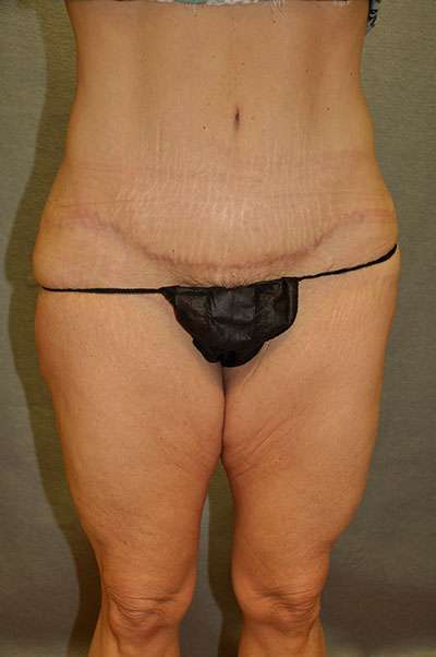 ABDOMINOPLASTY Before and After Results