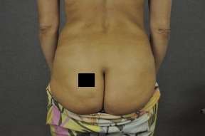 Fat Transfer Breast Augmentation Result Scottsdale