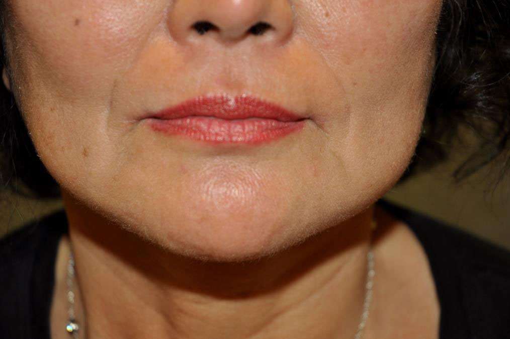 CORNER LIP LIFT Before and After Results